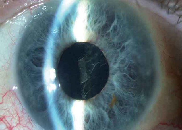 Снижение зрения через несколько лет после удаления катаракты