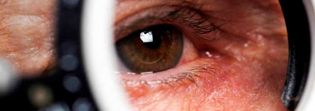 Помутнение роговицы глаза (бельмо) - эффективное лечение (в т.ч. операции)