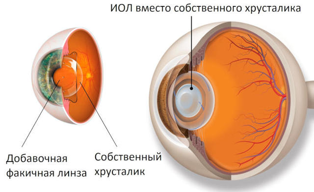 Улучшить зрение при тонкой роговице - лазерная коррекция или ИОЛ