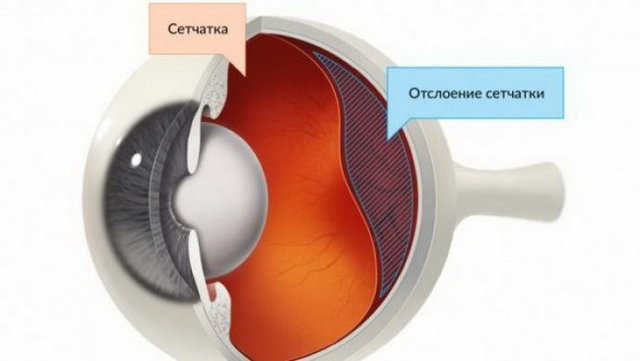 Операция по лечению отслойки сетчатки без очередей - сохраните зрение