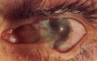 Ожог сетчатки глаза - эффективные методы лечения, причины и симптомы (признаки)