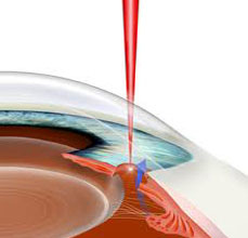Закрытоугольная глаукома - причины возникновения, симптомы и лечение
