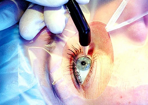 Витилиго и лазерная коррекция зрения - можно делать операцию?