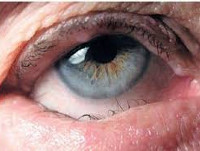 Заворот века глаза у человека (энтропион) - причины и эффективное лечение (операция блефаропластики)