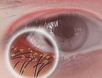Блефароконъюнктивит глаз: причины, симптомы и эффективные методы лечения заболевания