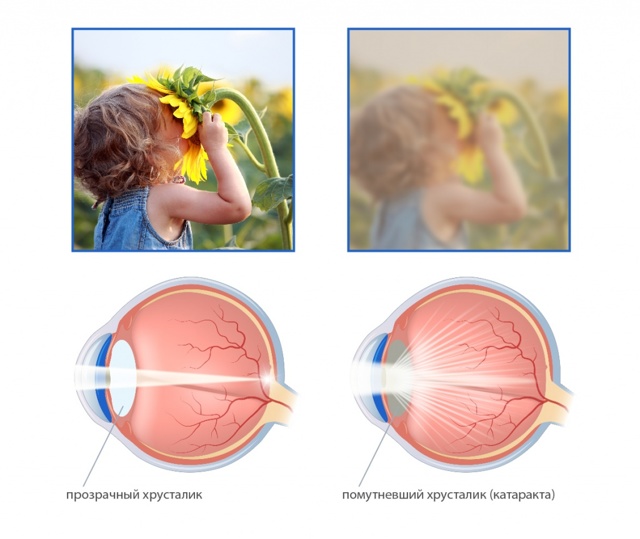 Восстановление и сохранение зрения при влажной ВМД и катаракте