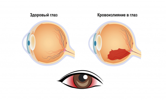Гемофтальм (кровоизлияние в глаз) после вакцинации от коронавируса