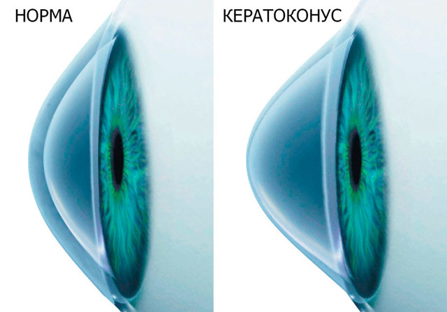 MyoRing (Миоринг) - роговичные кольца при кератоконусе