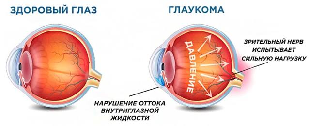 Острый приступ глаукомы: симптомы и неотложная помощь (лечение)