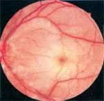 Постоклюзионная атрофия нерва и ишемическая нейрооптикопатия глаза