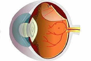 Отслойка сетчатки и кровоизлияние в глаз после вакцинации Спутником V