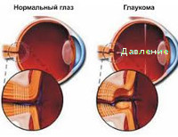 Вторичная глаукома: причины, лечение и классификация