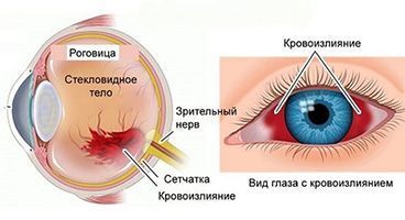 Хориоретинит с кровоизлиянием в сетчатку - как восстановить зрение