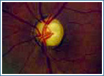 Классификация глаукомы - все виды глаукомы