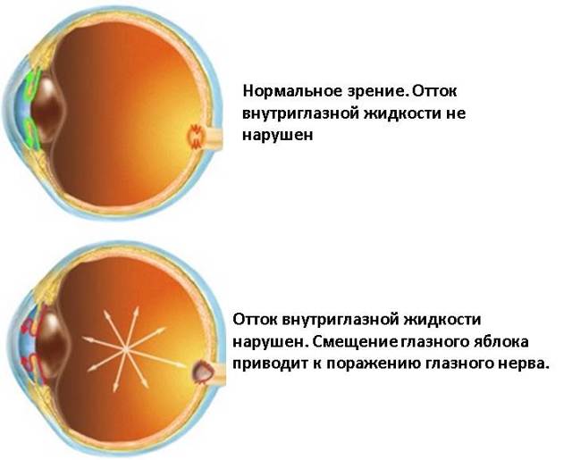 Повышение внутриглазного давления (глаукома) и температура тела