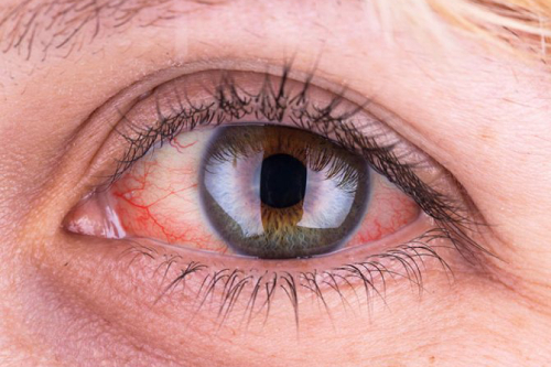 Сидероз и халькоз (металлозы глаз): причины, симптомы и эффективные методы лечения заболевания