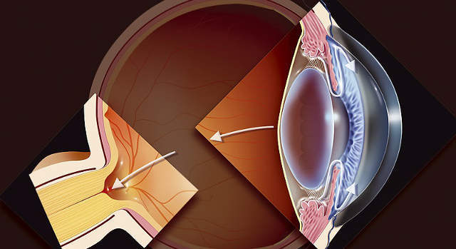 Измерение внутриглазного давления при глаукоме - как часто?