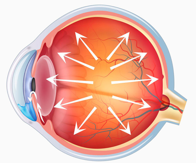 Глаукома нормального (низкого) давления