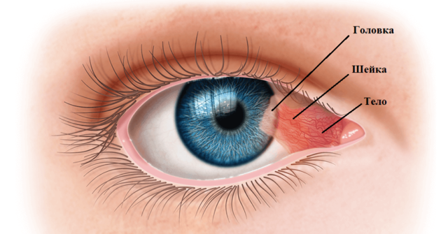 Пингвекула глаза и её эффективное лечение (капли и операция по удалению)