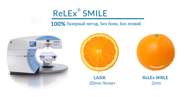 Роговичная лентикула при лазерной коррекции ReLEx SMILE