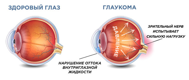 Закрытоугольная глаукома - причины возникновения, симптомы и лечение