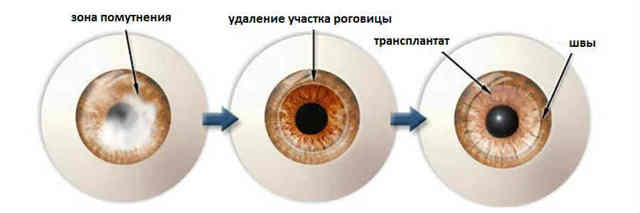Вакцинация от коронавируса после пересадки роговицы глаза