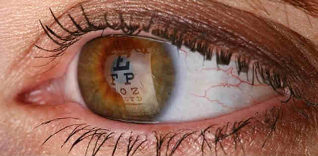 Лазерная коррекция зрения и ревматоидный артрит