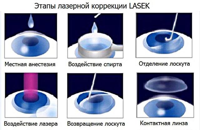 LASEK - лазерная субэпителиальная кератэктомия - преимущества операции, отзывы и цены!