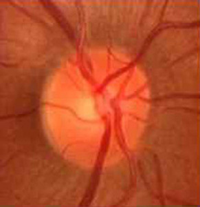 Восстановление зрения при мертвых (бледных) зрительных нервах